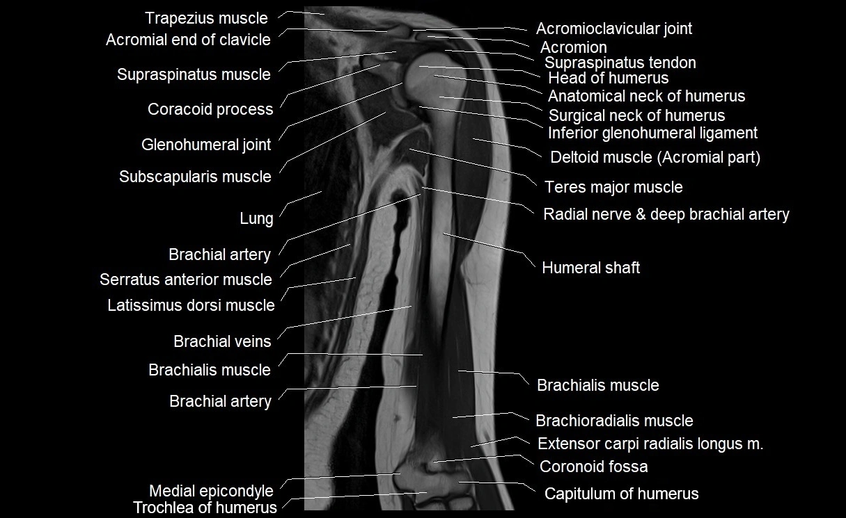 MRI upper arm (humerus ) coronal cross sectional anatomy image 14.webp
